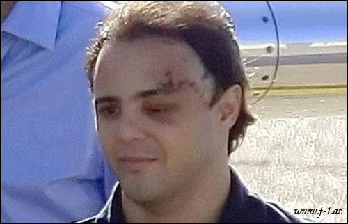 F.Massa hospitalı tərk edib F.Massa hospitalı tərk edib